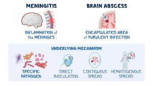 Image result for Brain Abscess