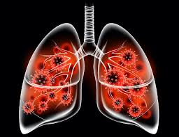 If a person with copd wants to gain weight, eating a variety of complex carbohydrates alongside healthful sources of fat and protein can help. Repurposing A Copd Drug For Covid 19 With Verona Pharma