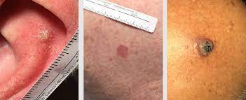 Of course, your specialist is the main person whose advice you should follow but it doesn't do anyone harm. Basal Cell Squamous Cell Skin Cancers Clear Dermatology