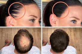 Wenn die haare bei frauen dünner werden, sollte vor allem auf frische kurzhaarschnitte oder mittellange frisuren gesetzt werden. Haarverdichtung Die Besten Methoden Nicht Operativ Ubersicht