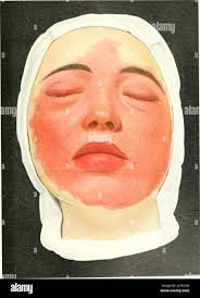 Image result for phlegmon on face)