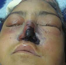 Mucormycosis, commonly known as black fungus, is a rare but serious fungal infection caused by a although the blackening of the face & area over the nose, etc can be seen in mucormycosis, there. Mucormycosis Wikidoc