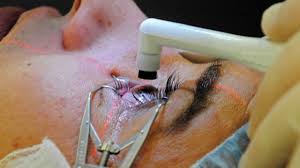 Laser eye surgery cost is high; Cataract Surgery Complications To Look Out For Irisvision