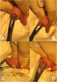 Image result for Neonatal Circumcision