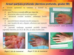 Cel mai simplu mod prin care poţi să răcoreşti şi să hidratezi pielea încinsă este să foloseşti apă rece. Pastile Pentru Arsuri De GrÄƒsime La Stomac Superstore ArsurÄƒ De GrÄƒsime AlbÄƒ