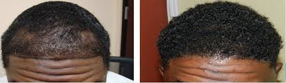 When choosing between african american hair transplant doctors, many patients seek out dr. Mens Hair Transplant Cost Harley Street Healthcarehair Transplant Clinic In London Manchester Birmingham Uk