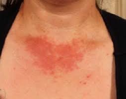Image result for Polymorphous Light Eruption
