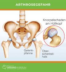 L'arthrose a longtemps été considérée comme une usure due au vieillissement, mais les recherches récentes tendent à démontrer qu'il s'agit bien d'un problème de santé à part entière. Arthrose Naturheilpraxis Gesund In Berlin
