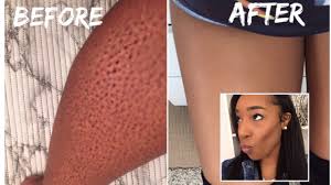 Some of the marks are red, others are black. How To Remove Ingrown Hairs How To Get Rid Of Ingrown Hairs Razor Bumps Strawberry Legs Youtube