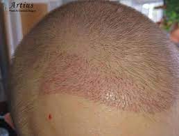 To view more of the before and after hair transplant surgery on clients with advanced hair loss bald head, please views this play list. Know Why Transplanted Hair Fall Out After 2 3 Weeks Of Surgery Artius Hair Transplant