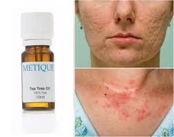 Rezultatele studiilor clinice negru dimensiune vorbesc de la sine! 10 Motive Pentru Care Ar Trebui Sa Folositi Uleiul De Arbore De Ceai Pe Piele