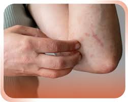 Image result for Hives