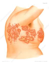 Image result for zoster under breasts