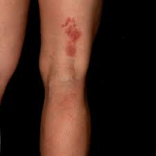 Check spelling or type a new query. Jak Vypada Pasovy Opar Infekcnost A Kde Se Nachazi Moje Zdravi