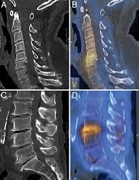 Primary Pain Generator Identification By Ct Spect In Patients With Degenerative Spinal Disease In Neurosurgical Focus Volume 47 Issue 6 2019