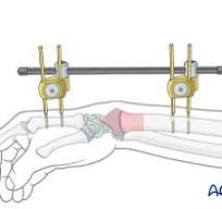 External fixation for Multifragmentary epiphysiolysis with ...