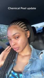 I had a small breakout but im still in love w my results #chemicalpeel  #melanxpeel #porestar #charettecosmetics #skincare