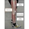 Both legs should be checked, although tendinitis usually only occurs in one leg. 1