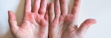 Image result for Contact Dermatitis