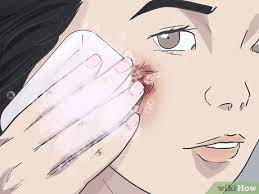 3 Easy Ways To Prevent Scarring On Your Face - Wikihow