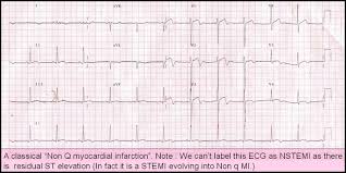 Uncertain if conversion was spontaneous, or done electrically in the cath lab rbbb and lafb persist (not a good sign). Is The Terminology Of Non Q Mi Obsolete Or Still Relevant Dr S Venkatesan Md