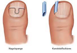 Behandlung Eines Eingewachsenen Zehennagels