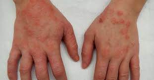 Pityriasis alba is a skin condition that commonly happens to children and to young adults, but any pityriasis alba is also correlated with another skin condition called eczema which still causes an itchy. Einloggen Klicke Hier Das Wp Menu Builder Zu Verwenden Einloggen Willkommen Anmeldung Zu Ihrem Konto Ihr Benutzername Kennwort Passwort Vergessen Password Recovery Gewinnen Sie Ihr Passwort Ihre E Mail Suche 14 2 C Paris Montag 2