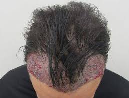 If you need to find your local post office, it's easier than ever before. Foto Trapianto Capelli Prima E Dopo Masullo Medical Group