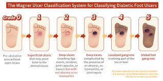 Image result for IDSA Diabetic Foot Wound Classification