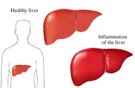 Hepatitis Nonviral