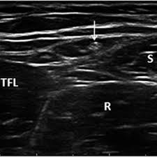 Lateral femoral cutaneous nerve ultrasound. Pdf Ultrasound Of The Lateral Femoral Cutaneous Nerve In Asymptomatic Adults
