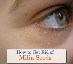 Sep 06, 2016 · here are the seven highly effective steps to safely removing milia at home: Milia Treatment Natural Ways To Remove Milia Create Better Skin Natural Beauty Skin Care