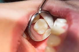 The neighboring tooth or teeth act as stabilizers while the damaged tooth heals. My Tooth Feels Loose Emergency Dentist Boyles General Dentistry