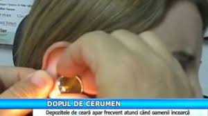 Complicatia cea mai frecventa a dopurilor de ceara este otita externa. Medicala Dopul De Cerumen Youtube