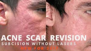 How much does scar revision in cost? Acne Scar Treatments Treatment For Acne Scars Acne Scar Treatments Brisbane