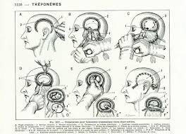 1912 Trepanation Operation Du Cerveau Boite Cranienne Crane Etsy Weird Humanoid Sketch Art