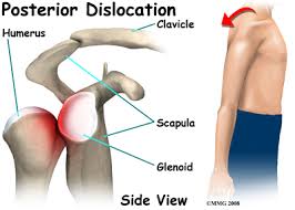 Image result for Shoulder Dislocation