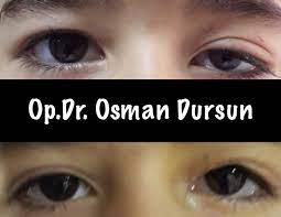 goz kapagi dusuklugu