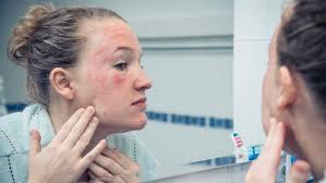 Despite intensive topical therapy, treatment with oral corticosteroids and oral doxycycline was unable to achieve suff …. How To Treat Rosacea According To A Dermatologist