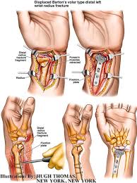 Ny Construction Accident Lawyer Medical Illustrations New York Construction Lawyer Medical Illustration Hand Therapy Orthopedic Nursing