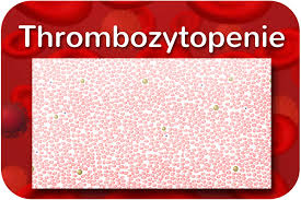 Im eigentlichen sinn sind sie keine blutzellen sondern nur bruchstücke, die häufig eine bizarre. Thrombozytopenie Thrombopenie Zu Wenig Thrombozyten