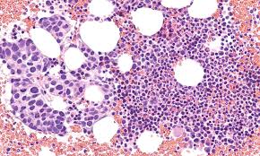 In this stage, this is where the cancer has spread to other areas on the body. Quick Facts On Metastatic Breast Cancer Nih Medlineplus Magazine