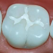 With this method, each grout line is brushed individually with a since the surface of the ceramic tile is glazed, it is already sealed. Penhold Red Deer Teeth Sealants Penhold Dental Care