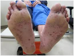 Coxsackieviruses are divided into group a and group b viruses based on early observations of their pathogenicity in mice. Coxsackie A6 Infection Atypical Hand Foot Mouth Disease In The Us Military A Case Series