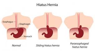Is Gerd A Symptom Of A Hiatal Hernia Hiatus Hernia Gastric Sleeve Surgery Sleeve Surgery