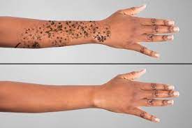 How To Remove Stick And Poke Tattoos Lovetoknow Laser Tattoo Laser Tattoo Removal Tattoo Removal Cream