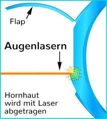 Augenlasern In Osnabruck Vor Und Nachteile Kosten Kliniken