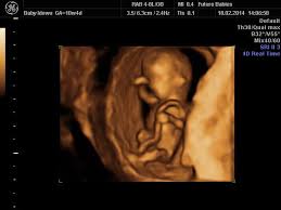 A 10 week pregnancy ultrasound can reveal exact fetal age thus calculation of exact due date is possible. 3d Image Of A Baby At 10 Weeks Gestation Baby At 10 Weeks Future Baby Beautiful Images