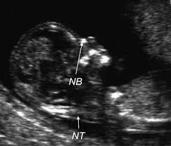 Nuchal Translucency And Other First Trimester Sonographic Markers Of Chromosomal Abnormalities American Journal Of Obstetrics Gynecology