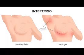 Image result for Intertrigo under breasts